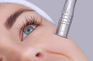 Microdermabrasion Smethwick West Midlands