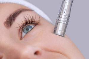 Microdermabrasion Sileby Leicestershire