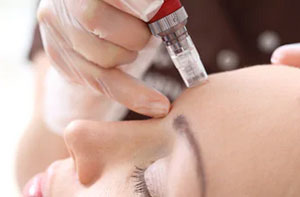 Microneedling Kimberley (NG16) Microneedling Kimberley (NG16)